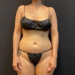 High Definition Liposuction Before & After Patient #5558