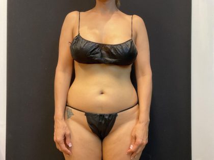 High Definition Liposuction Before & After Patient #5558