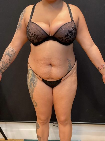 The Skinny Shot Before & After Patient #5599