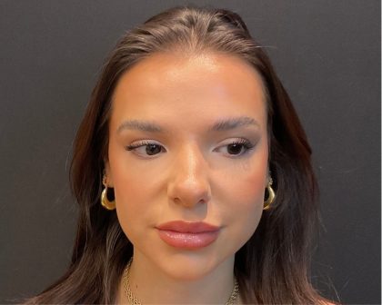 Rhinoplasty Before & After Patient #5646