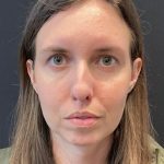 Rhinoplasty Before & After Patient #5648