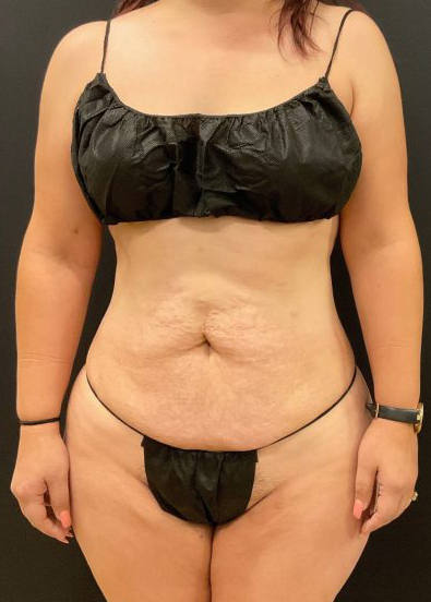 Mommy Makeover Before & After Patient #5635