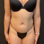 High Definition Liposuction Before & After Patient #5560