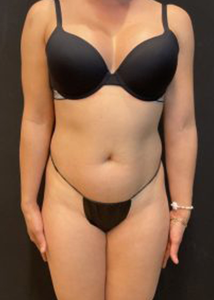 High Definition Liposuction Before & After Patient #5560