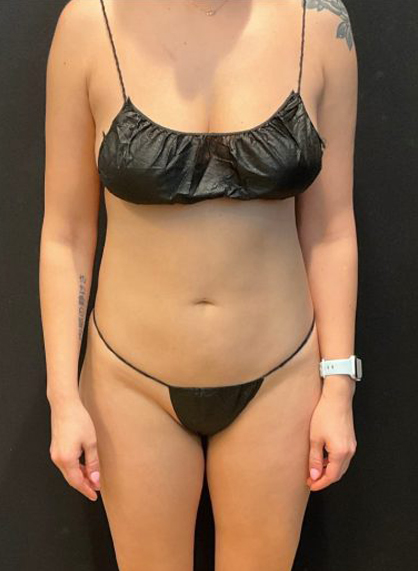 High Definition Liposuction Before & After Patient #5523