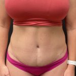 The Skinny Shot Before & After Patient #5475