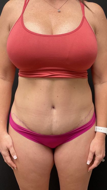 The Skinny Shot Before & After Patient #5475
