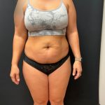 The Skinny Shot Before & After Patient #5477