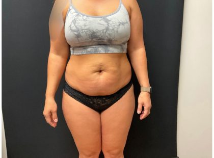 The Skinny Shot Before & After Patient #5477