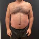 The Skinny Shot Before & After Patient #5479