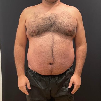 The Skinny Shot Before & After Patient #5479