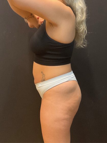 The Skinny Shot Before & After Patient #5599