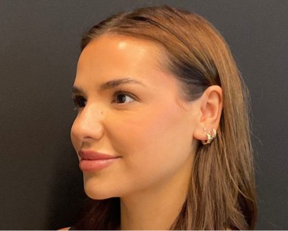 Rhinoplasty Before & After Patient #5646