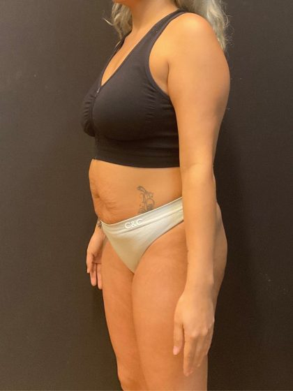 The Skinny Shot Before & After Patient #5599