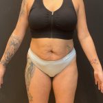The Skinny Shot Before & After Patient #5599