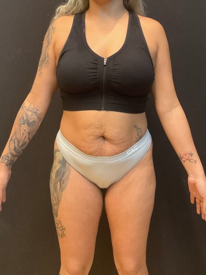 The Skinny Shot Before & After Patient #5599