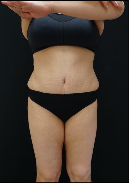 Tummy Tuck Before & After Patient #5076