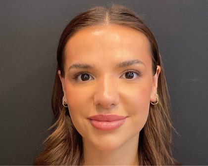 Rhinoplasty Before & After Patient #5646