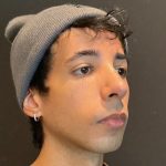 Rhinoplasty Before & After Patient #5647