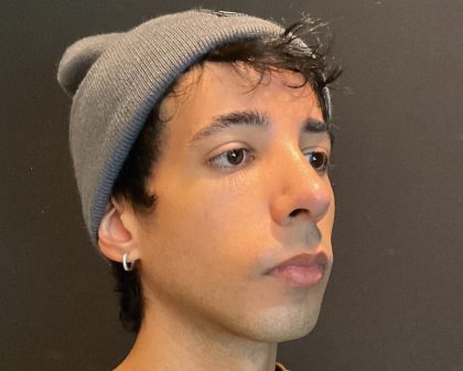 Rhinoplasty Before & After Patient #5647