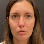 Rhinoplasty Before & After Patient #5648