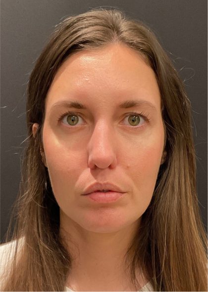 Rhinoplasty Before & After Patient #5648