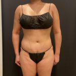 Tummy Tuck Before & After Patient #5074