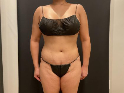 Tummy Tuck Before & After Patient #5074