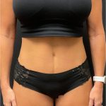 The Skinny Shot Before & After Patient #5475