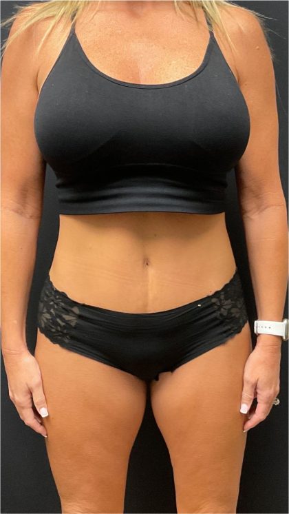 The Skinny Shot Before & After Patient #5475
