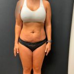 The Skinny Shot Before & After Patient #5477