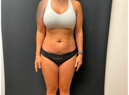 The Skinny Shot Before & After Patient #5477