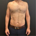 The Skinny Shot Before & After Patient #5479