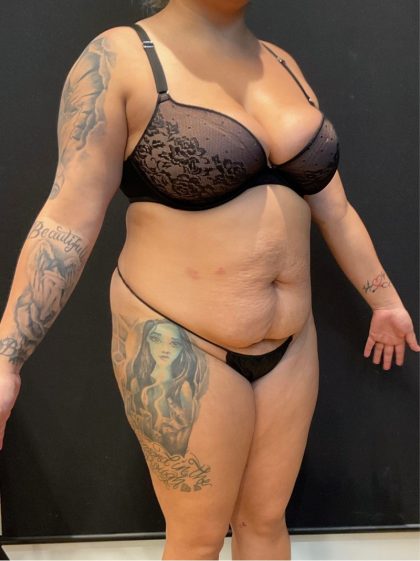 The Skinny Shot Before & After Patient #5599