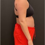 The Skinny Shot Before & After Patient #5600