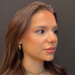 Rhinoplasty Before & After Patient #5646