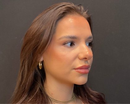 Rhinoplasty Before & After Patient #5646