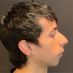 Rhinoplasty Before & After Patient #5647