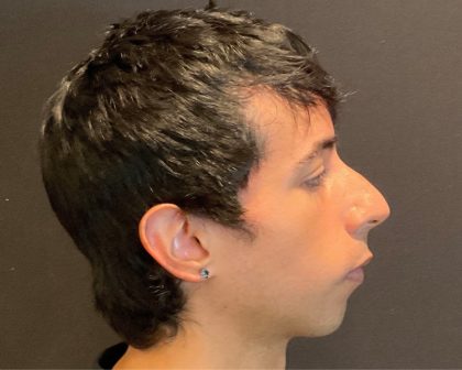 Rhinoplasty Before & After Patient #5647