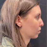 Rhinoplasty Before & After Patient #5648