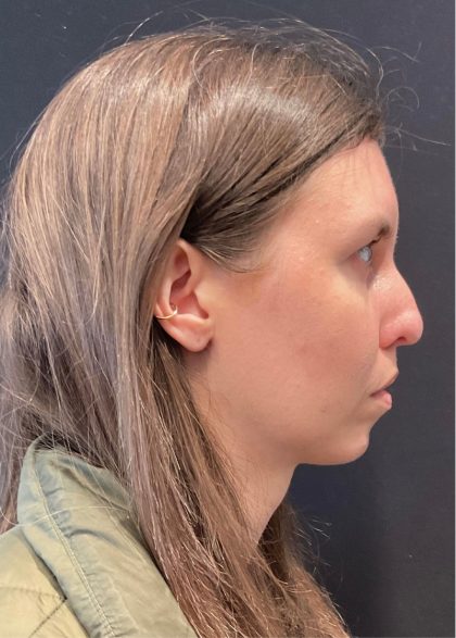 Rhinoplasty Before & After Patient #5648