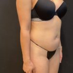 High Definition Liposuction Before & After Patient #5560