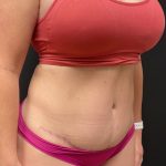 The Skinny Shot Before & After Patient #5475