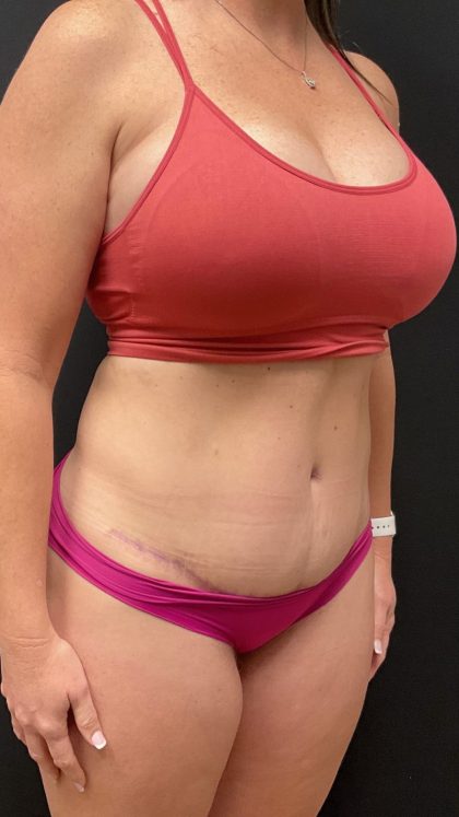 The Skinny Shot Before & After Patient #5475
