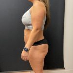 The Skinny Shot Before & After Patient #5477