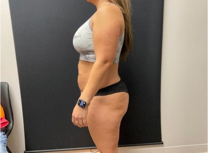 The Skinny Shot Before & After Patient #5477