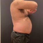 The Skinny Shot Before & After Patient #5479