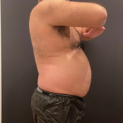 The Skinny Shot Before & After Patient #5479