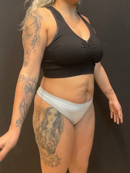 The Skinny Shot Before & After Patient #5599
