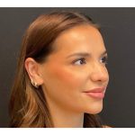 Rhinoplasty Before & After Patient #5646